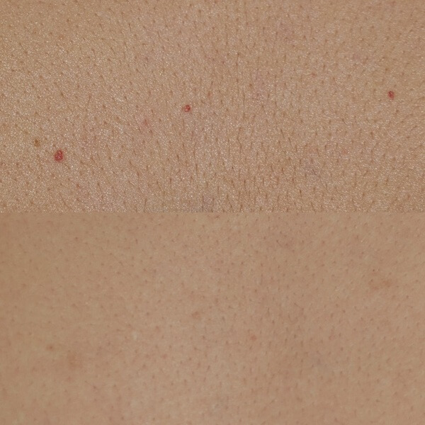 Vビーム2による治療を行った患者様の写真